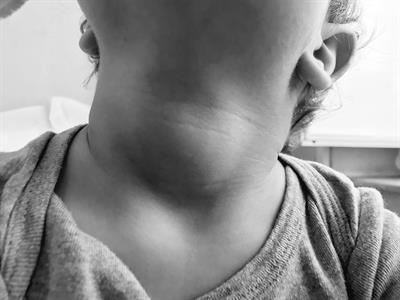Case report: Goiter and overt hypothyroidism in an iodine-deficient toddler on soy milk and hypoallergenic diet